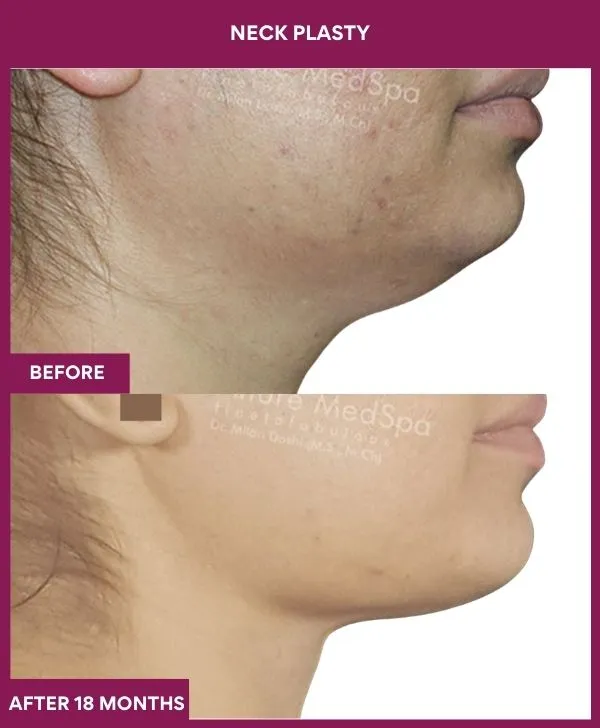 neck-lift-surgery-before-after-results-mumbai-india-patient02-side-right