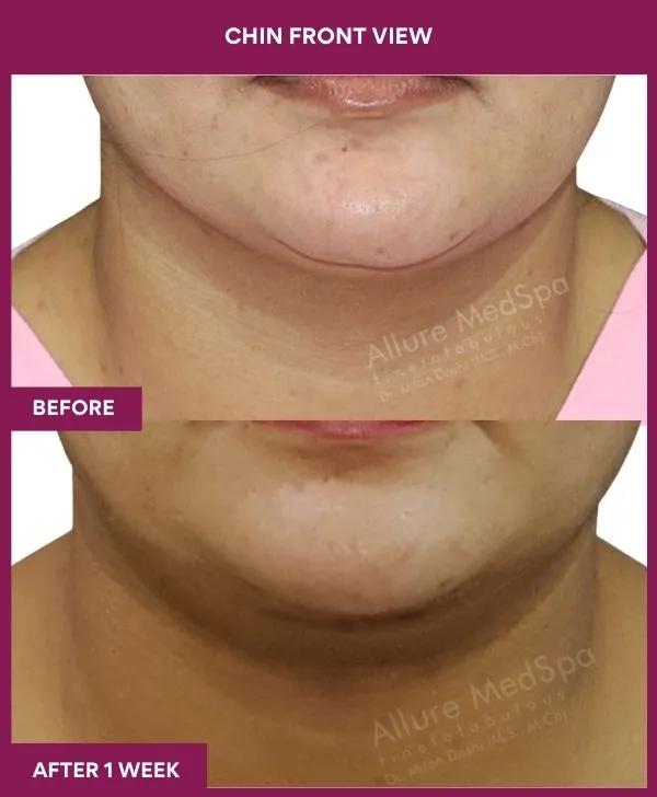 neck-lift-surgery-before-after-results-mumbai-india-patient03-front