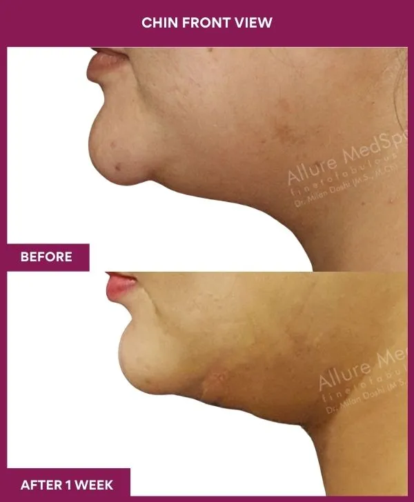 neck-lift-surgery-before-after-results-mumbai-india-patient03-side-left