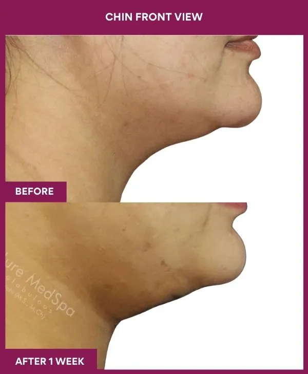 neck-lift-surgery-before-after-results-mumbai-india-patient03-side-right