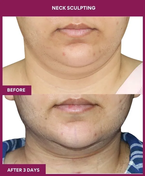 neck-lift-surgery-before-after-results-mumbai-india-patient04-front