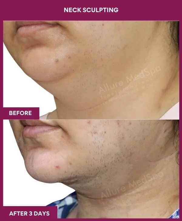 neck-lift-surgery-before-after-results-mumbai-india-patient04-side-left