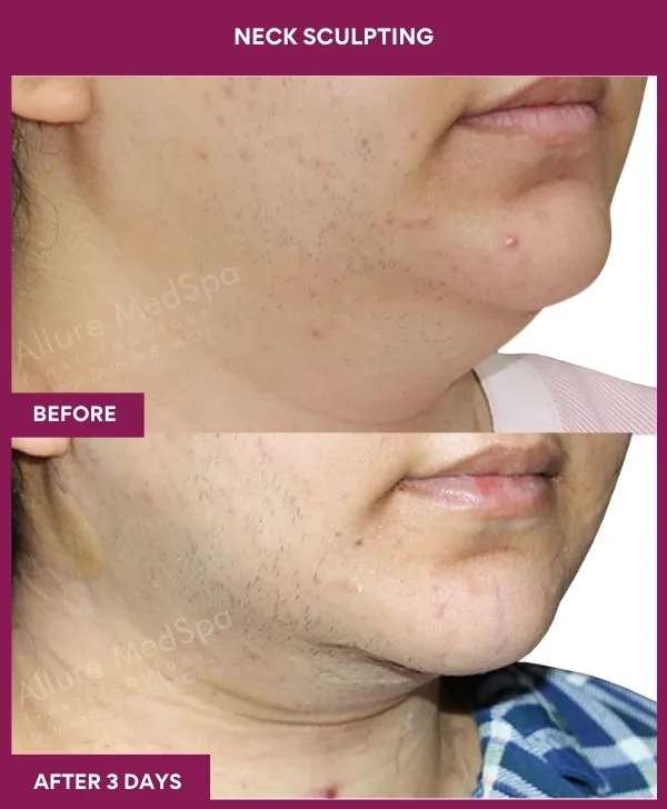 neck-lift-surgery-before-after-results-mumbai-india-patient04-side-right