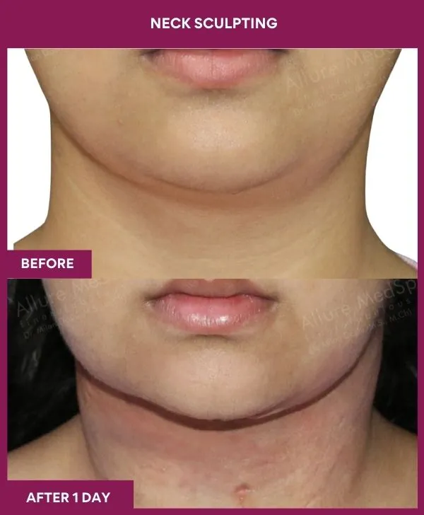 neck-lift-surgery-before-after-results-mumbai-india-patient05-front