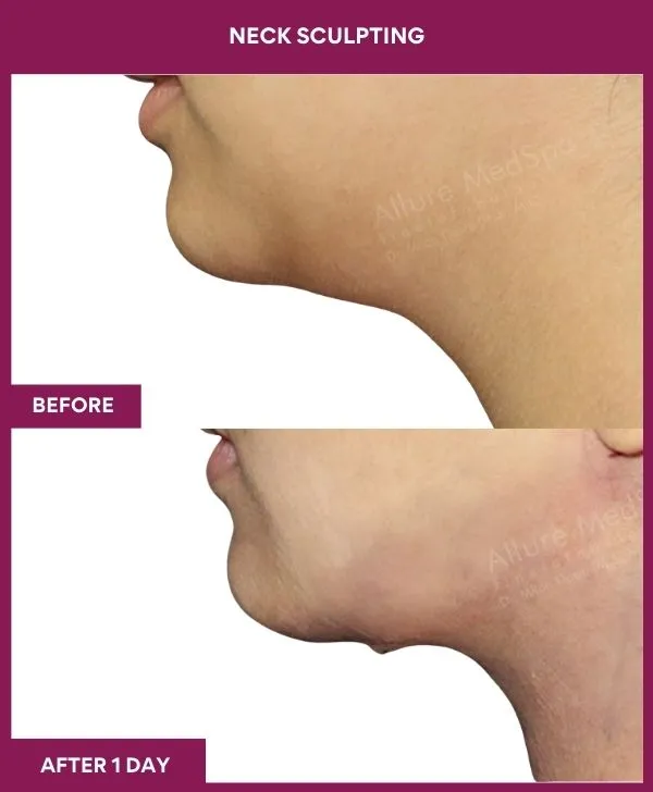 neck-lift-surgery-before-after-results-mumbai-india-patient05-side-left