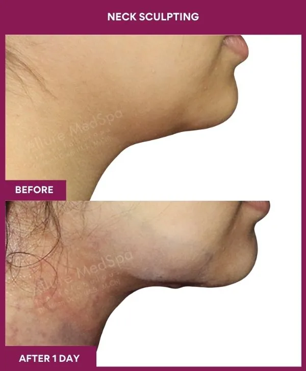 neck-lift-surgery-before-after-results-mumbai-india-patient05-side-right
