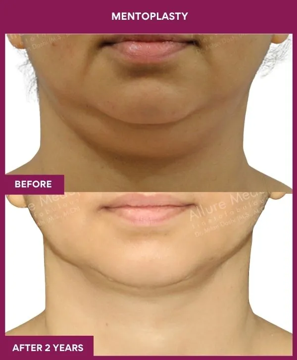 neck-lift-surgery-before-after-results-mumbai-india-patient06-front
