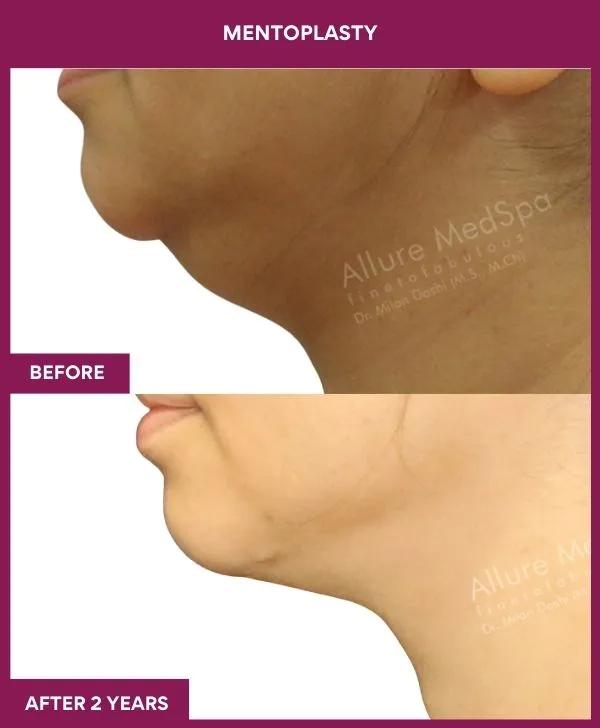 neck-lift-surgery-before-after-results-mumbai-india-patient06-side-left