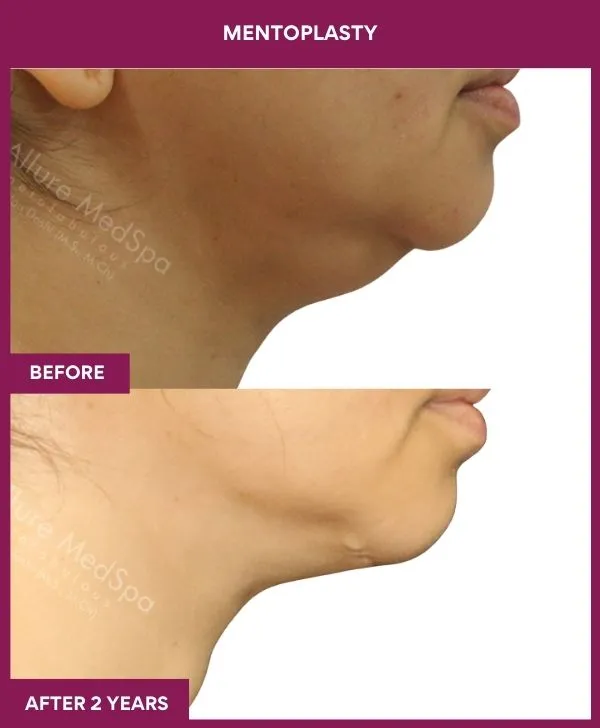neck-lift-surgery-before-after-results-mumbai-india-patient06-side-right