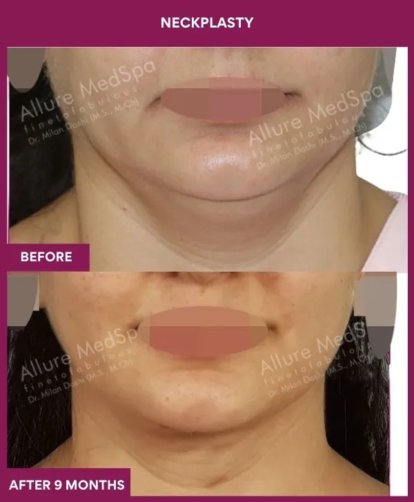 neck-lift-surgery-before-after-results-mumbai-india-patient07-front