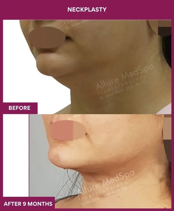 neck-lift-surgery-before-after-results-mumbai-india-patient07-side-left