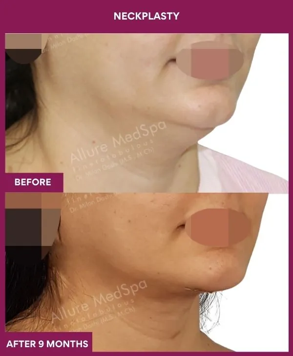 neck-lift-surgery-before-after-results-mumbai-india-patient07-side-right