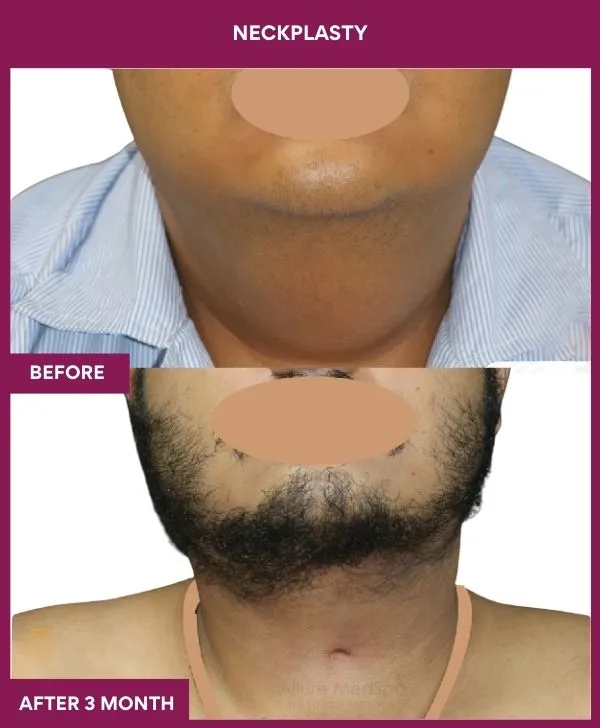 neck-lift-surgery-before-after-results-mumbai-india-patient08-front