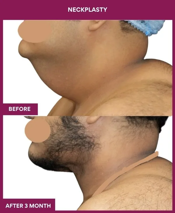 neck-lift-surgery-before-after-results-mumbai-india-patient08-side-left