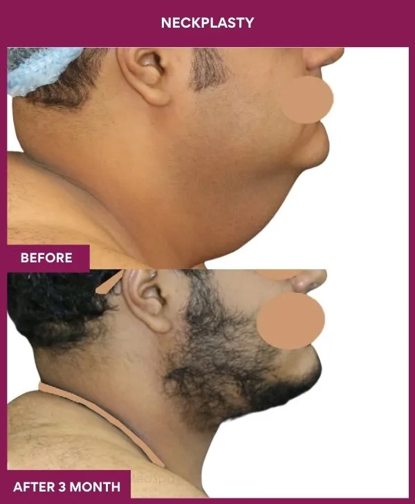 neck-lift-surgery-before-after-results-mumbai-india-patient08-side-right