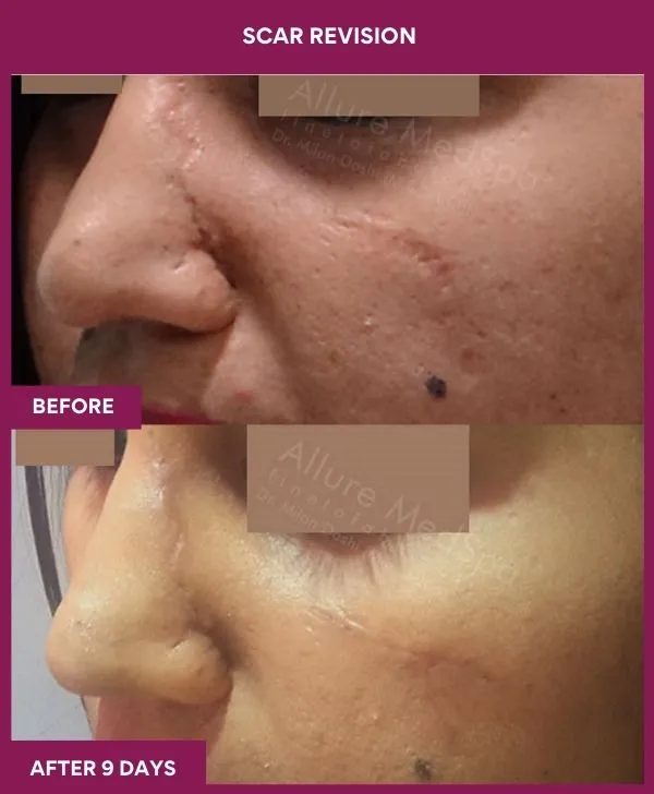 scar-revision-surgery-cheek-before-after-results-mumbai-india-patient03-close-up