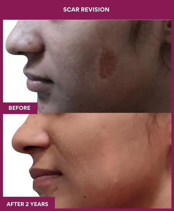 scar-revision-surgery-cheek-before-after-results-mumbai-india-patient04-close-up