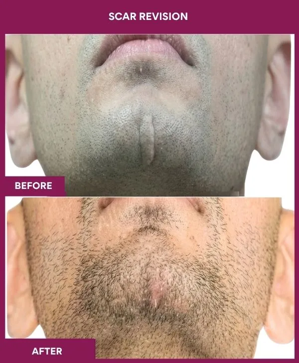 scar-revision-surgery-chin-before-after-results-mumbai-india-patient09-close-up
