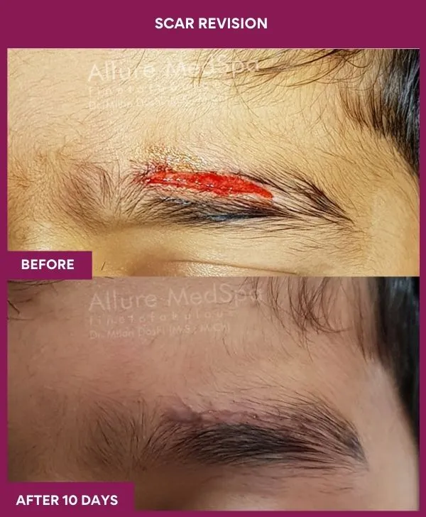 scar-revision-surgery-eyebrow-before-after-results-mumbai-india-patient01-close-up