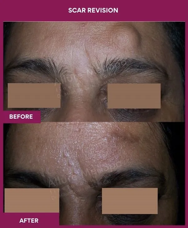 scar-revision-surgery-forehead-before-after-results-mumbai-india-patient02-close-up