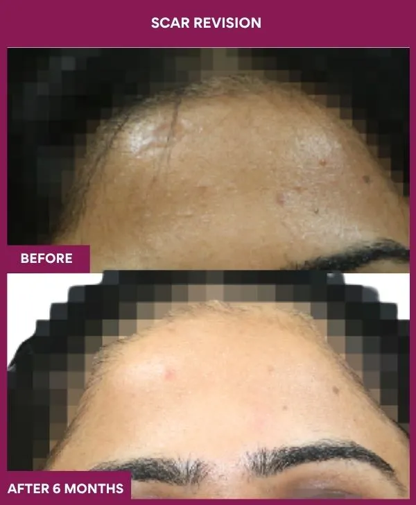 scar-revision-surgery-forehead-before-after-results-mumbai-india-patient08-close-up