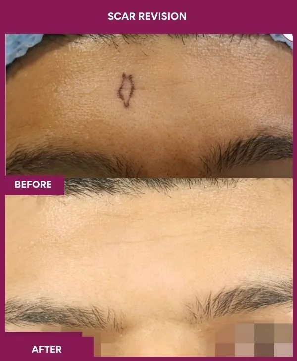 scar-revision-surgery-forehead-before-after-results-mumbai-india-patient10-close-up