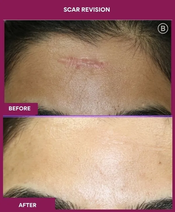 scar-revision-surgery-forehead-before-after-results-mumbai-india-patient11-close-up
