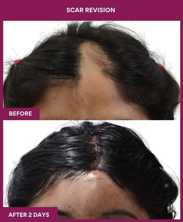 scar-revision-surgery-head-before-after-results-mumbai-india-patient07-close-up