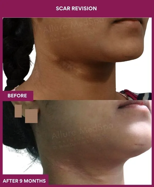 scar-revision-surgery-neck-before-after-results-mumbai-india-patient05-close-up