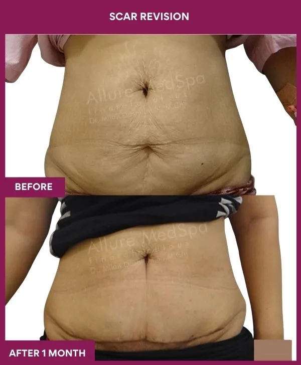 scar-revision-surgery-stomach-before-after-results-mumbai-india-patient06-close-up