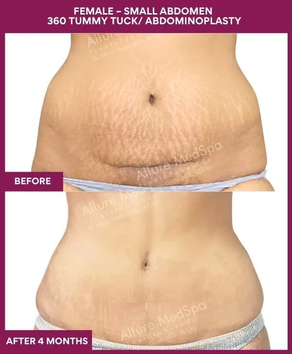 small-female-360-tummy-tuck-before-after-results-mumbai-india-patient02-front