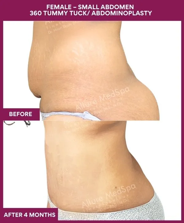 small-female-360-tummy-tuck-before-after-results-mumbai-india-patient02-side-left