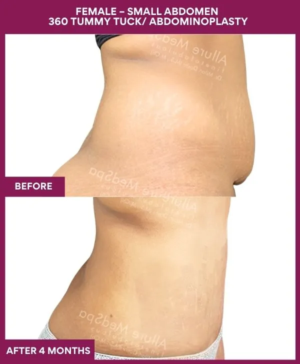 small-female-360-tummy-tuck-before-after-results-mumbai-india-patient02-side-right