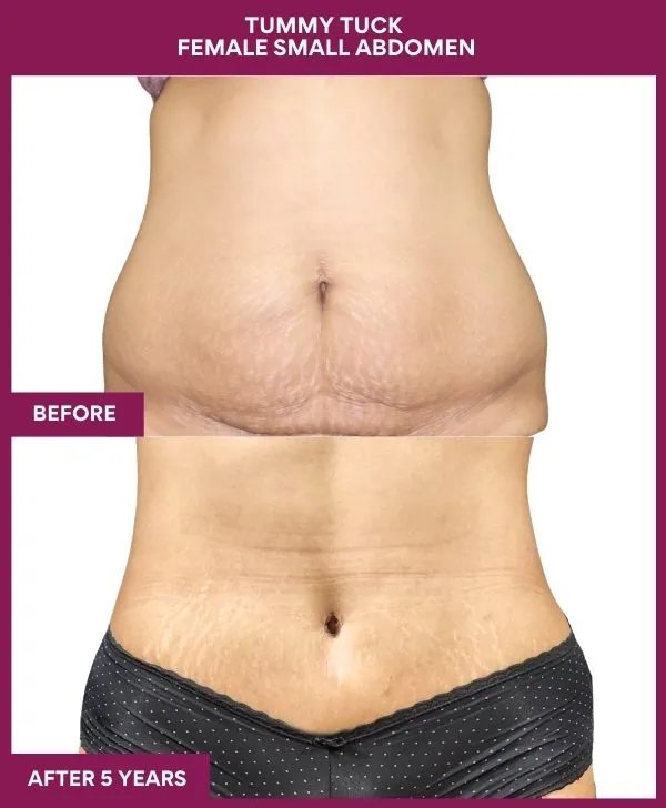 small-female-360-tummy-tuck-before-after-results-mumbai-india-patient04-front