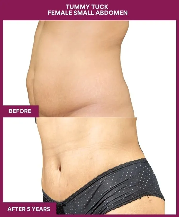 small-female-360-tummy-tuck-before-after-results-mumbai-india-patient04-side-left