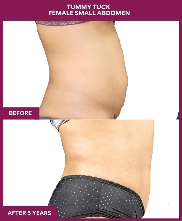 small-female-360-tummy-tuck-before-after-results-mumbai-india-patient04-side-right