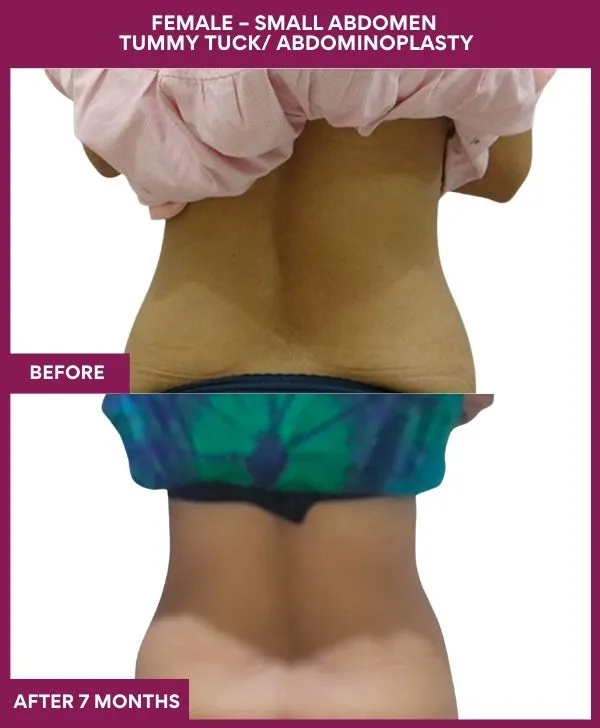small-female-360-tummy-tuck-before-after-results-mumbai-india-patient05-back