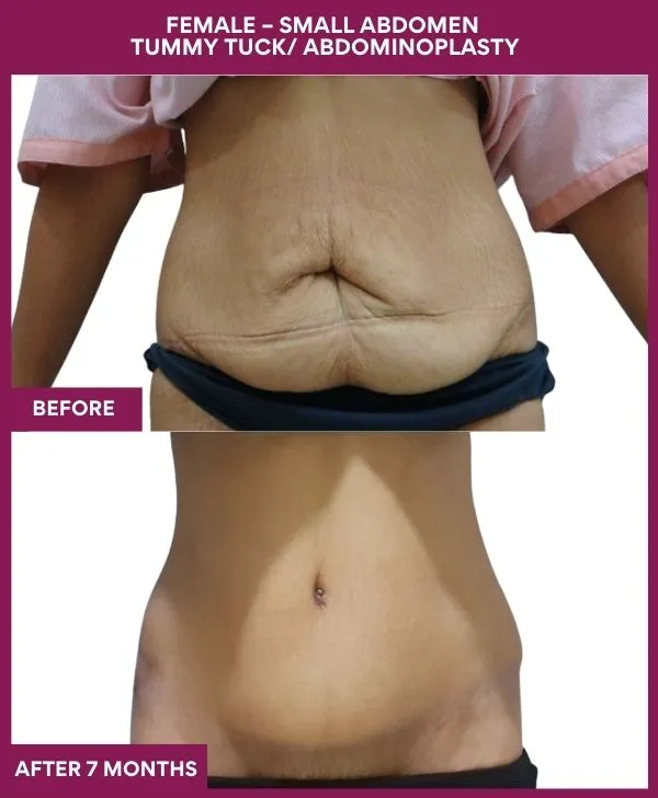 small-female-360-tummy-tuck-before-after-results-mumbai-india-patient05-front