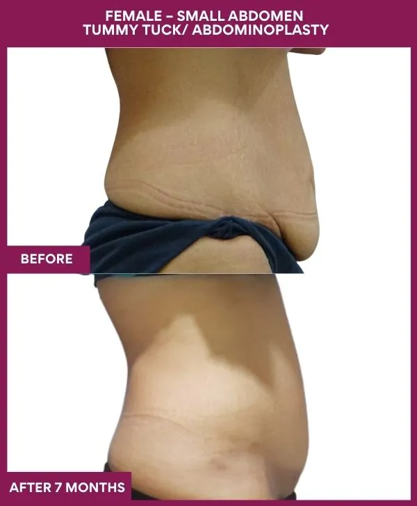 small-female-360-tummy-tuck-before-after-results-mumbai-india-patient05-side-right