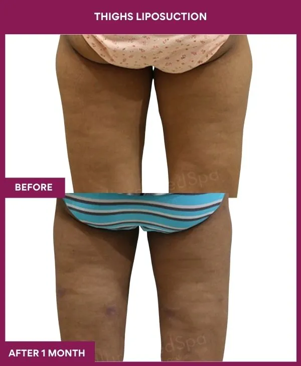 thigh-liposuction-before-after-results-mumbai-india-patient01-back