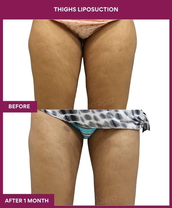 thigh-liposuction-before-after-results-mumbai-india-patient01-front