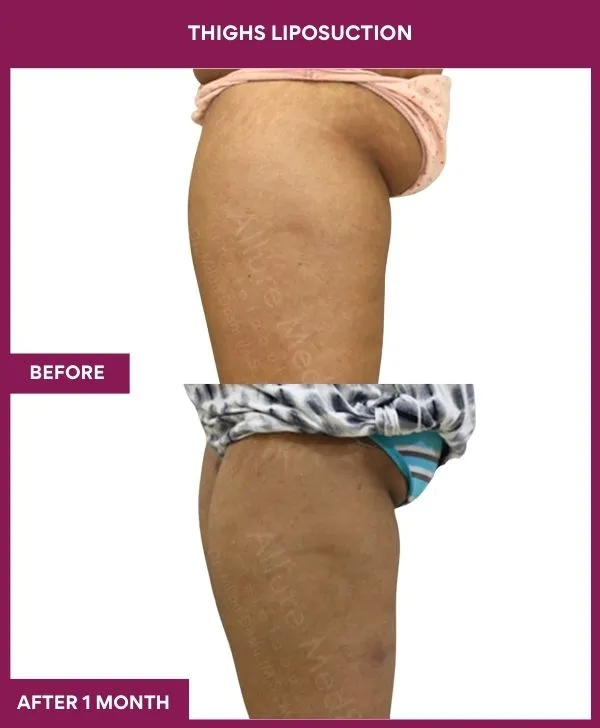 thigh-liposuction-before-after-results-mumbai-india-patient01-side-left