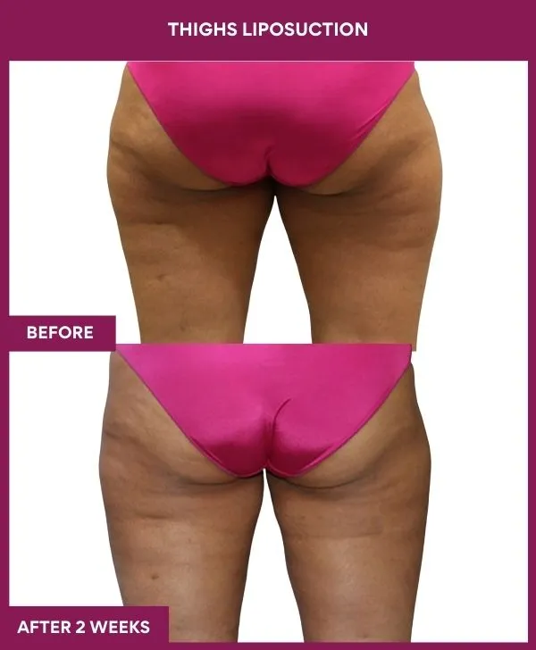 thigh-liposuction-before-after-results-mumbai-india-patient02-back
