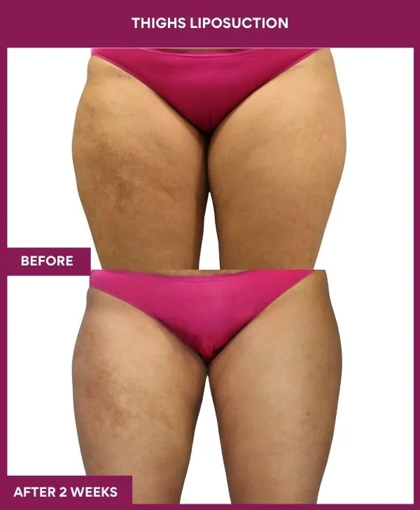 thigh-liposuction-before-after-results-mumbai-india-patient02-front
