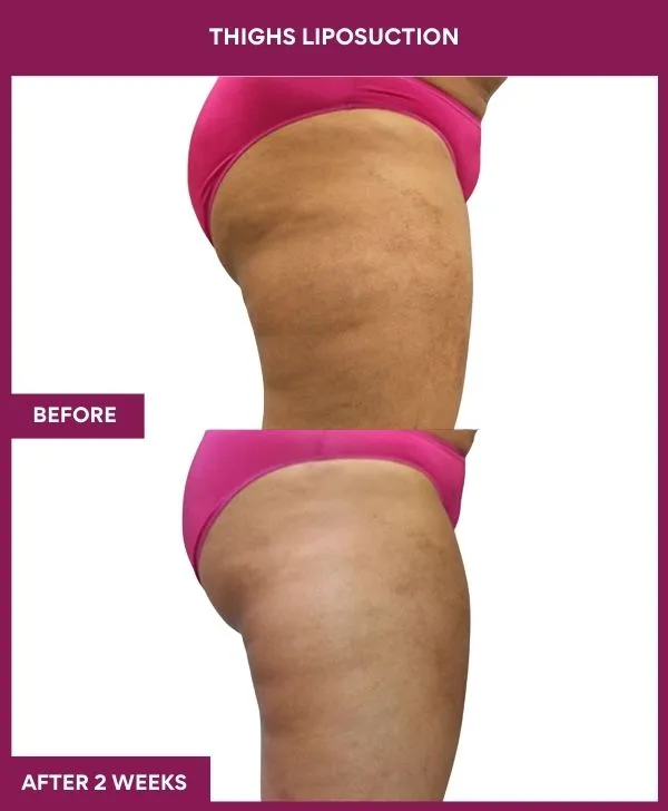 thigh-liposuction-before-after-results-mumbai-india-patient02-side-right