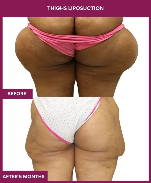 thigh-liposuction-before-after-results-mumbai-india-patient03-back