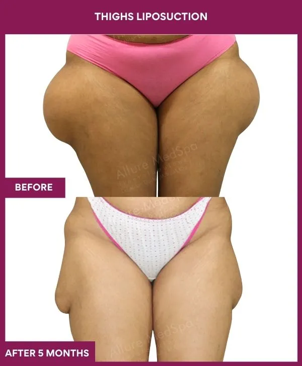 thigh-liposuction-before-after-results-mumbai-india-patient03-front