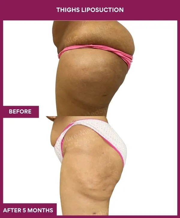 thigh-liposuction-before-after-results-mumbai-india-patient03-side-left