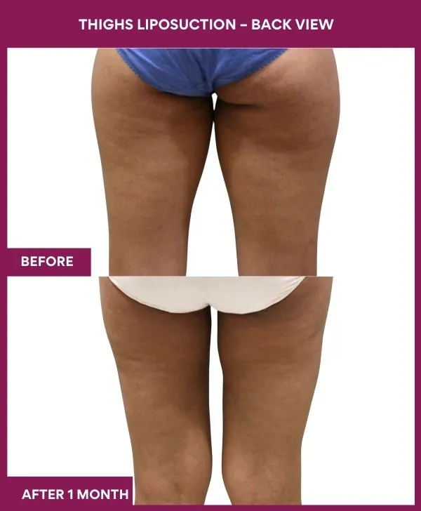 thigh-liposuction-before-after-results-mumbai-india-patient04-back