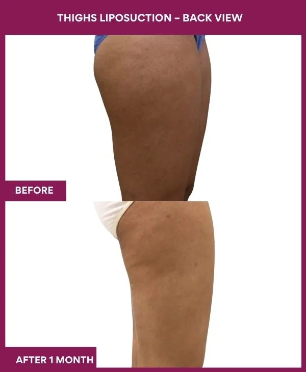 thigh-liposuction-before-after-results-mumbai-india-patient04-side-right